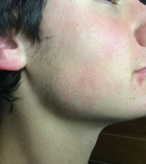 Teenage Boy's Face with Acne